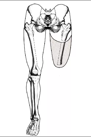 大腿假肢的各種組合
