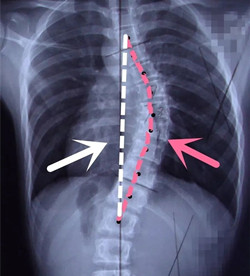 脊柱側(cè)彎后身高會(huì)變短嗎？