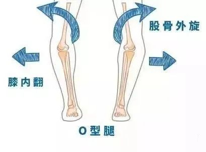 孩子“O”型腿怎么辦？