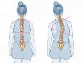 怕耽誤學(xué)習(xí)，脊柱側(cè)彎就不治療了嗎？
